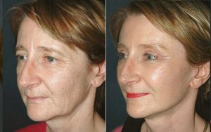 résultat lifting visage