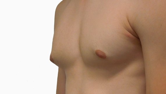 chirurgie-gynecomastie